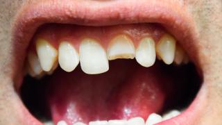 Suun ja hampaiden tapaturmat