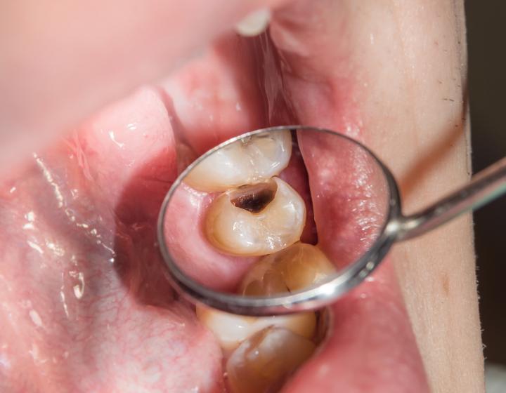 Kariesvaurio hampaassa