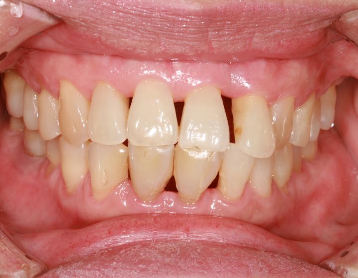 Parodontiitti eli hampaiden kiinnityskudossairaus